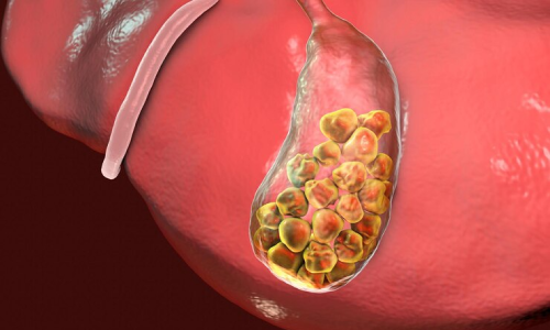 Gallstones treatment in Manikonda